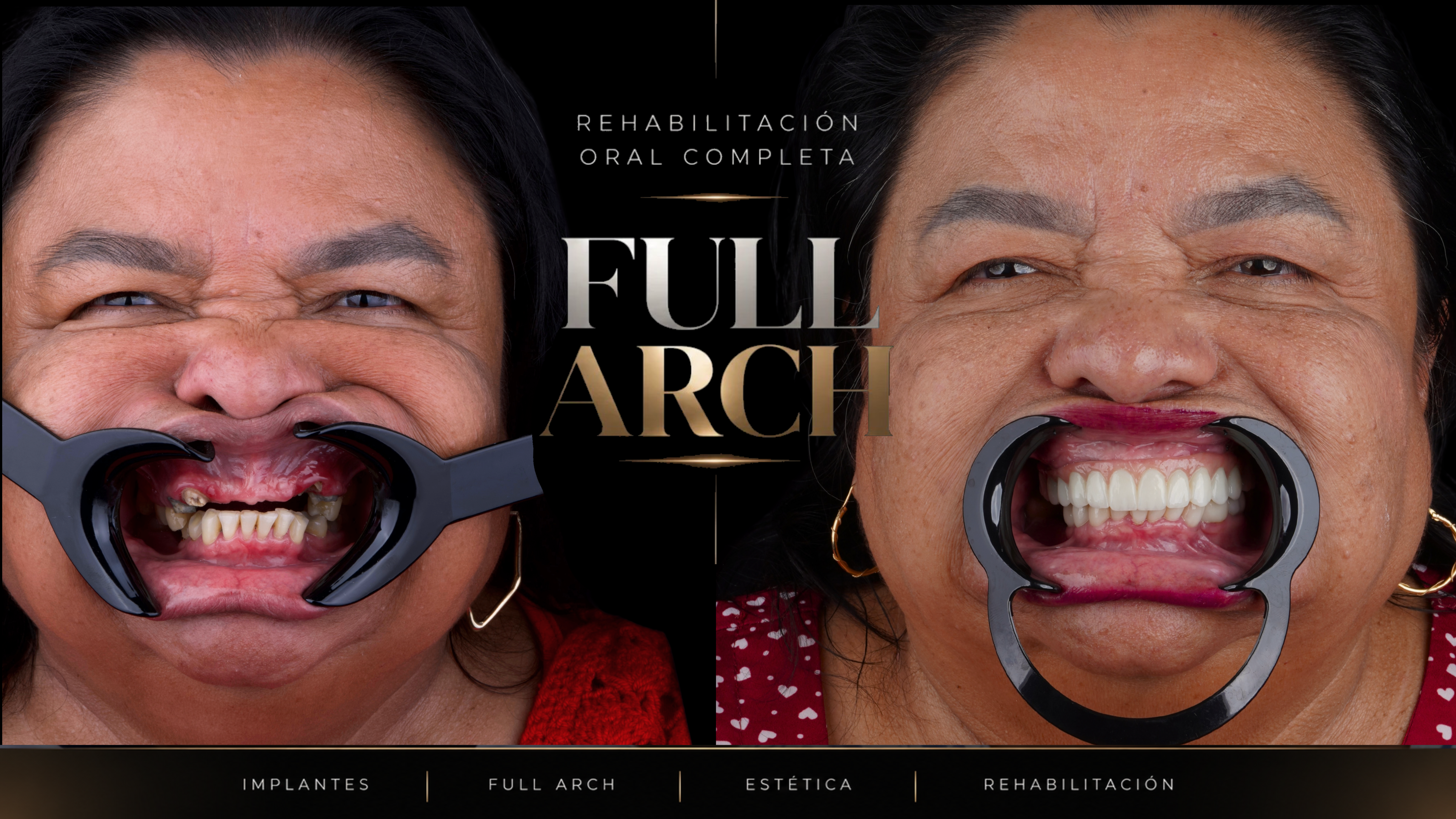 Caso Full Arch All-on-6 superior: antes del tratamiento y después con prótesis fija completa, carillas y coronas — rehabilitación oral IMPLANTI