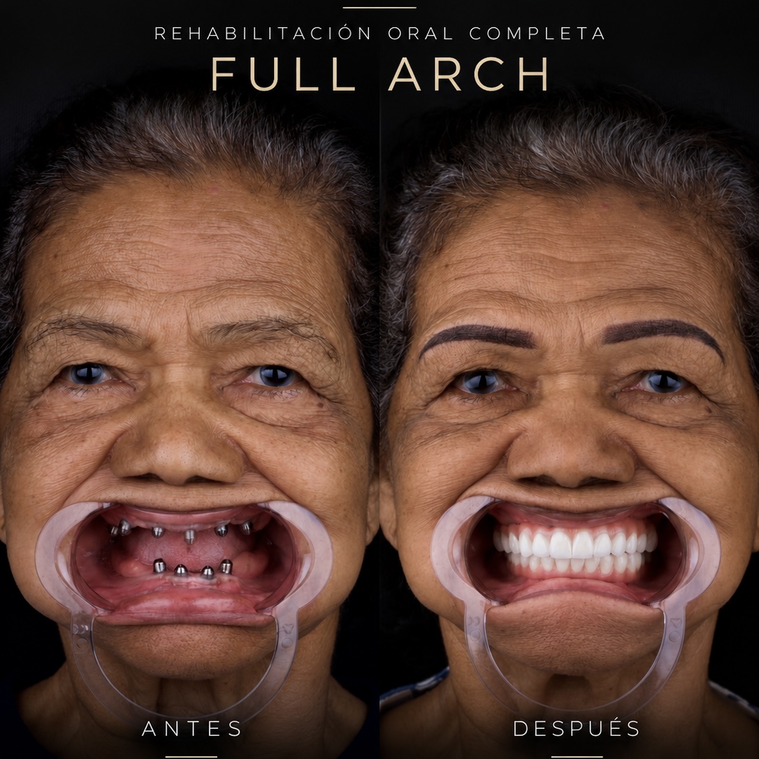 Caso Full Arch: antes con implantes colocados y después con prótesis fija completa — rehabilitación oral IMPLANTI